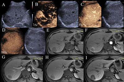 CEUS and CT/MRI LI-RADS in Association With Serum Biomarkers for Differentiation of Combined Hepatocellular-Cholangiocarcinoma From Hepatocellular Carcinoma